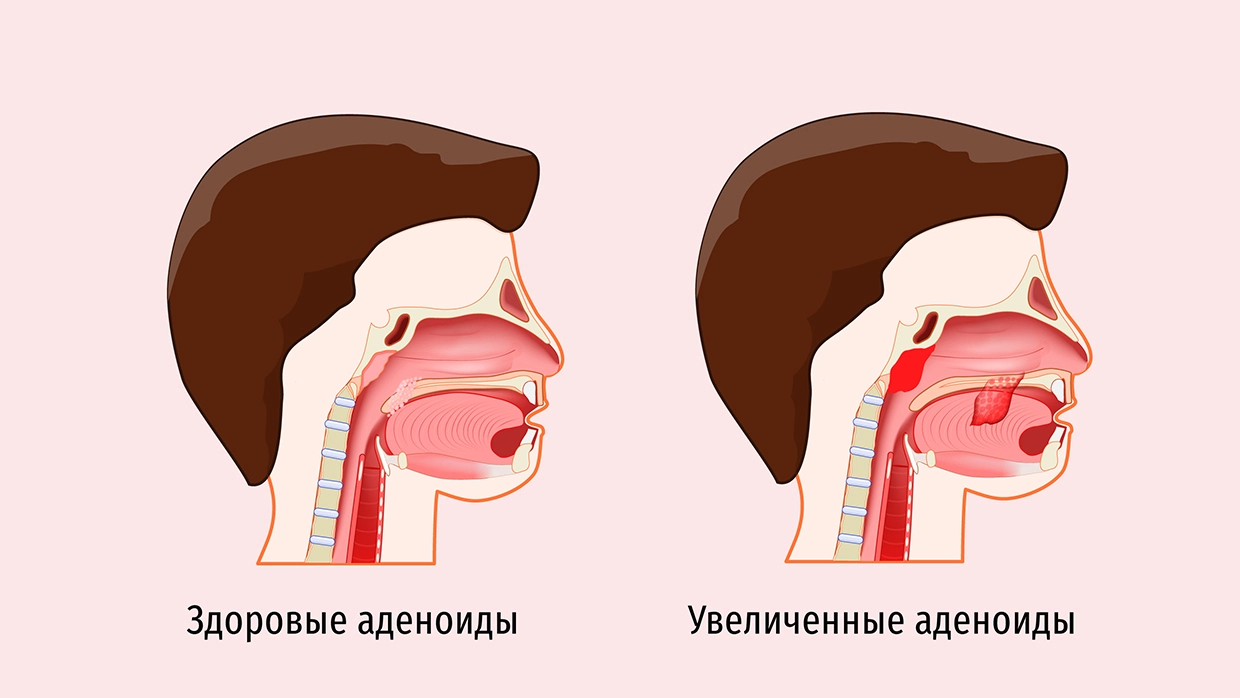 2. Затрудненное дыхание и храп